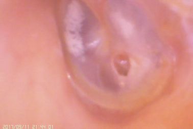 Timpanik Membran Perforasyonu için Video Kulak Ve Burun C amera Dijital Otoskop