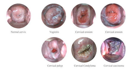Taşınabilir Dijital Elektronik Kolposkop