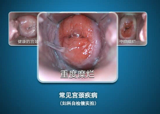 Gözlem Aralığı ile Dijital Endoskop Kendini İnceleyen Kolposkop Mini Kolposkopi 70 ~ 100mm