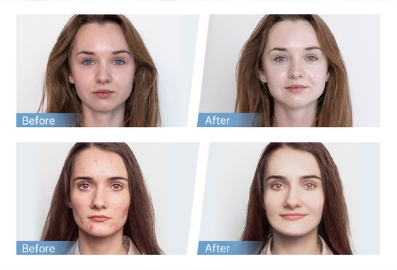 En Yeni 4 Kutuplu EMS Otomatik Serum Uygulayıcı Hydra Pen H5 Yüz Cilt Derma Mikro İğneleme Kalemi Esans Kolajen Yenilenmesi