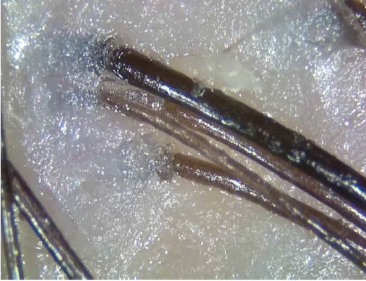 Polarize Işık ile Taşınabilir Kablosuz Dijital Cilt Analizörü Teletıp Teşhis Cihazı