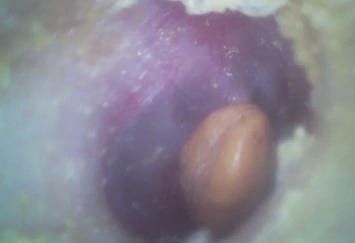 Taşınabilir KBB Kapsamı 32G Micro SD Flash Kartlı Ekonomik Elde Taşınabilir Dijital Video Otoskop