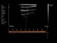 BIO-W4 Linear Scans Carotid Artery PW Mode
